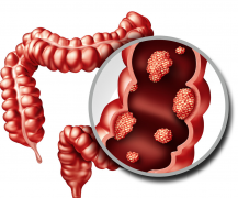 去医院做哪些检查可以确诊结肠癌？