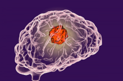 射波刀治疗脑肿瘤效果怎么样？